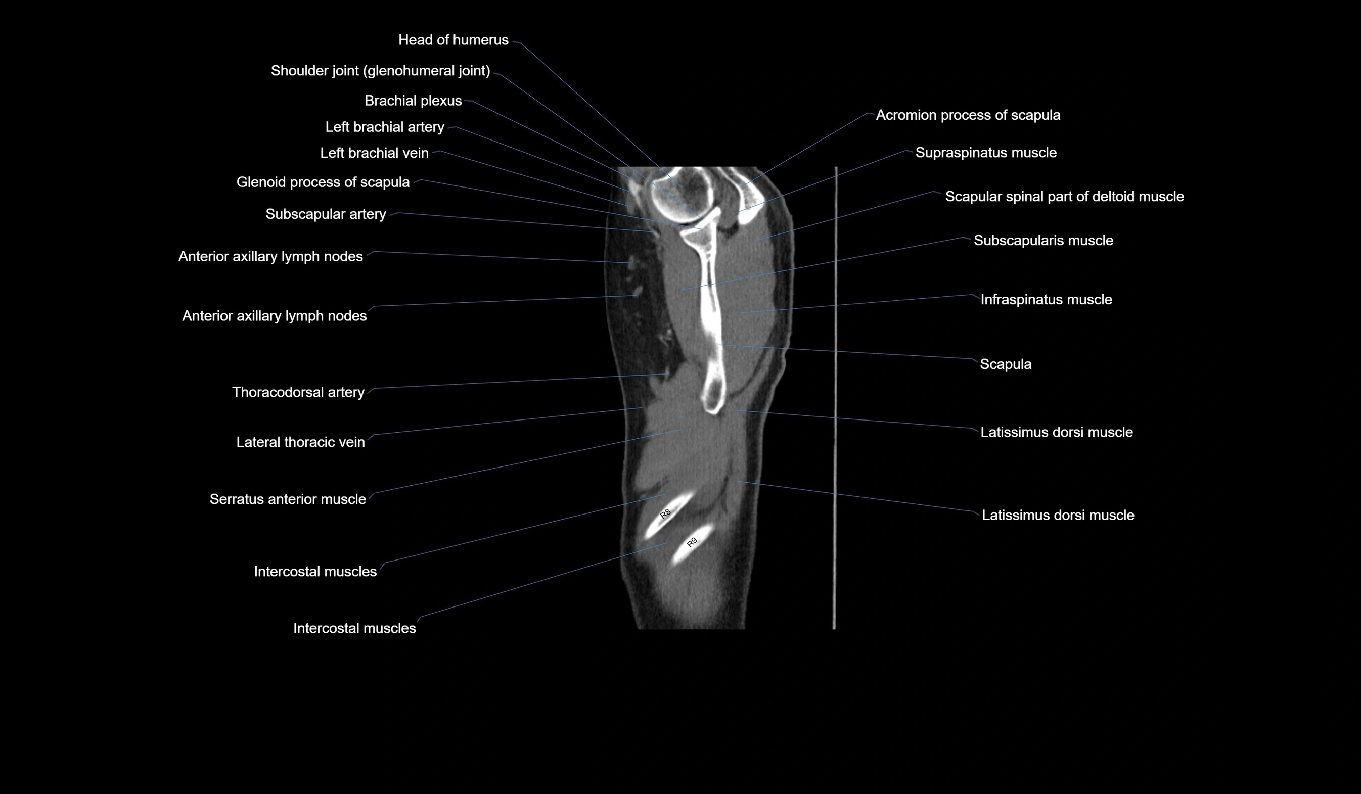 CT chest (thorax) labelled sagittal cross sectional anatomy radiology image-00135.webp